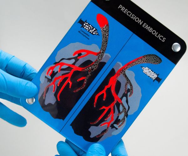 tiny spherical devices used in medical procedures to block or reduce blood flow to specific areas of the body