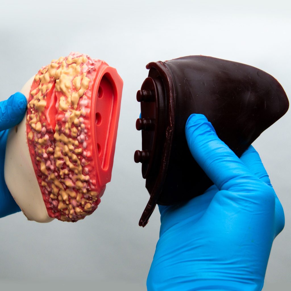 a 3-piece liver; fatty, cirrhotic, and a portion having hidden lesions that are only detectable by ultrasound