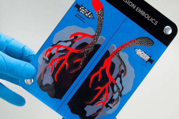 tiny spherical devices used in medical procedures to block or reduce blood flow to specific areas of the body